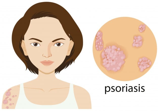 Castor Oil For Psoriasis